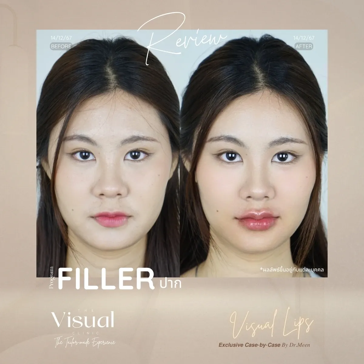 Lips Filler