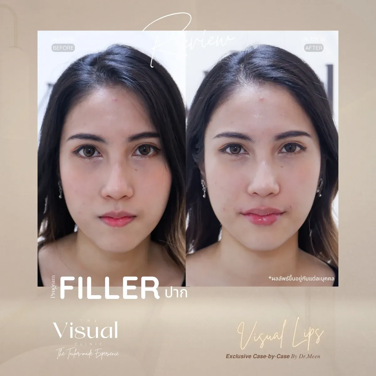 Lips Filler
