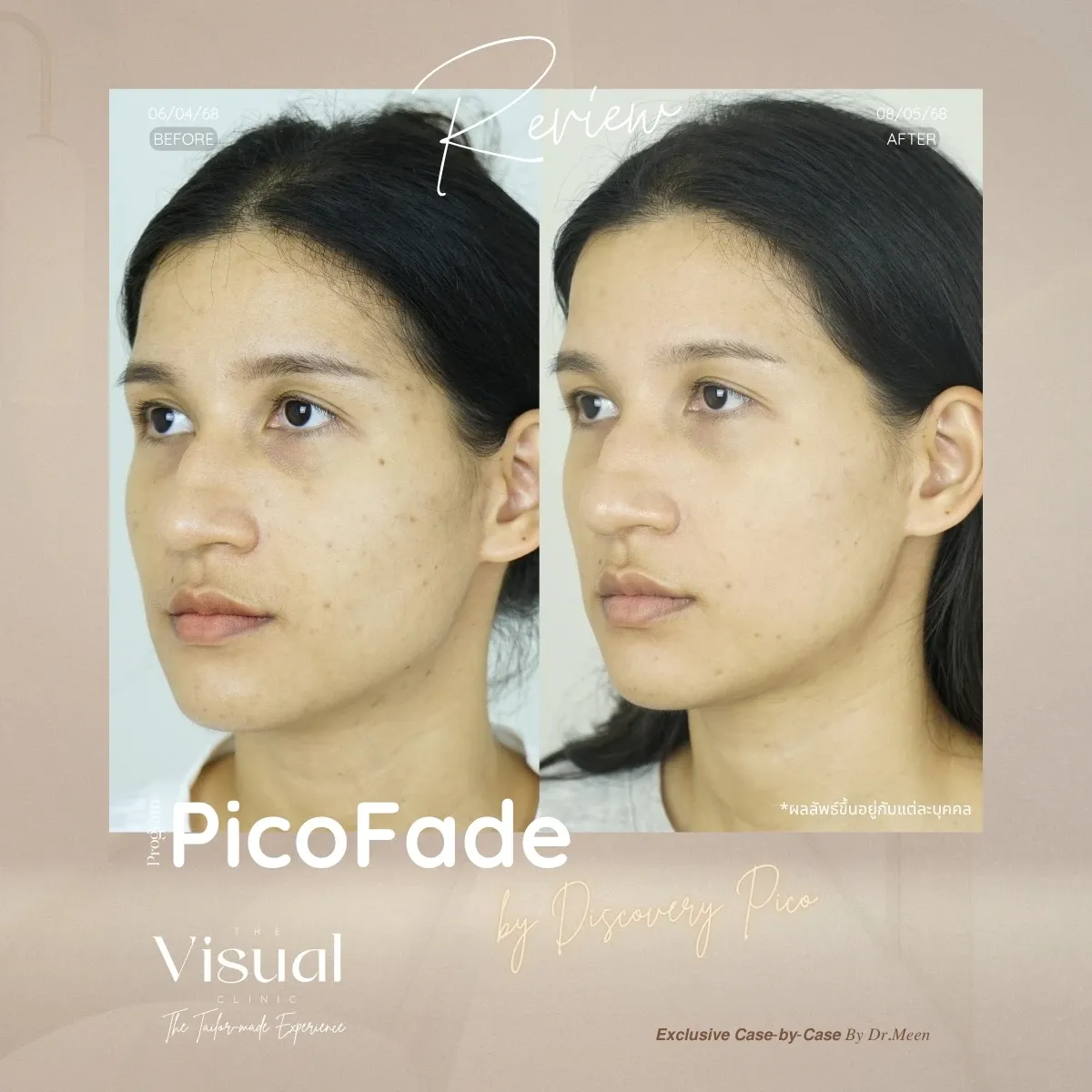 Program Discovery Pico