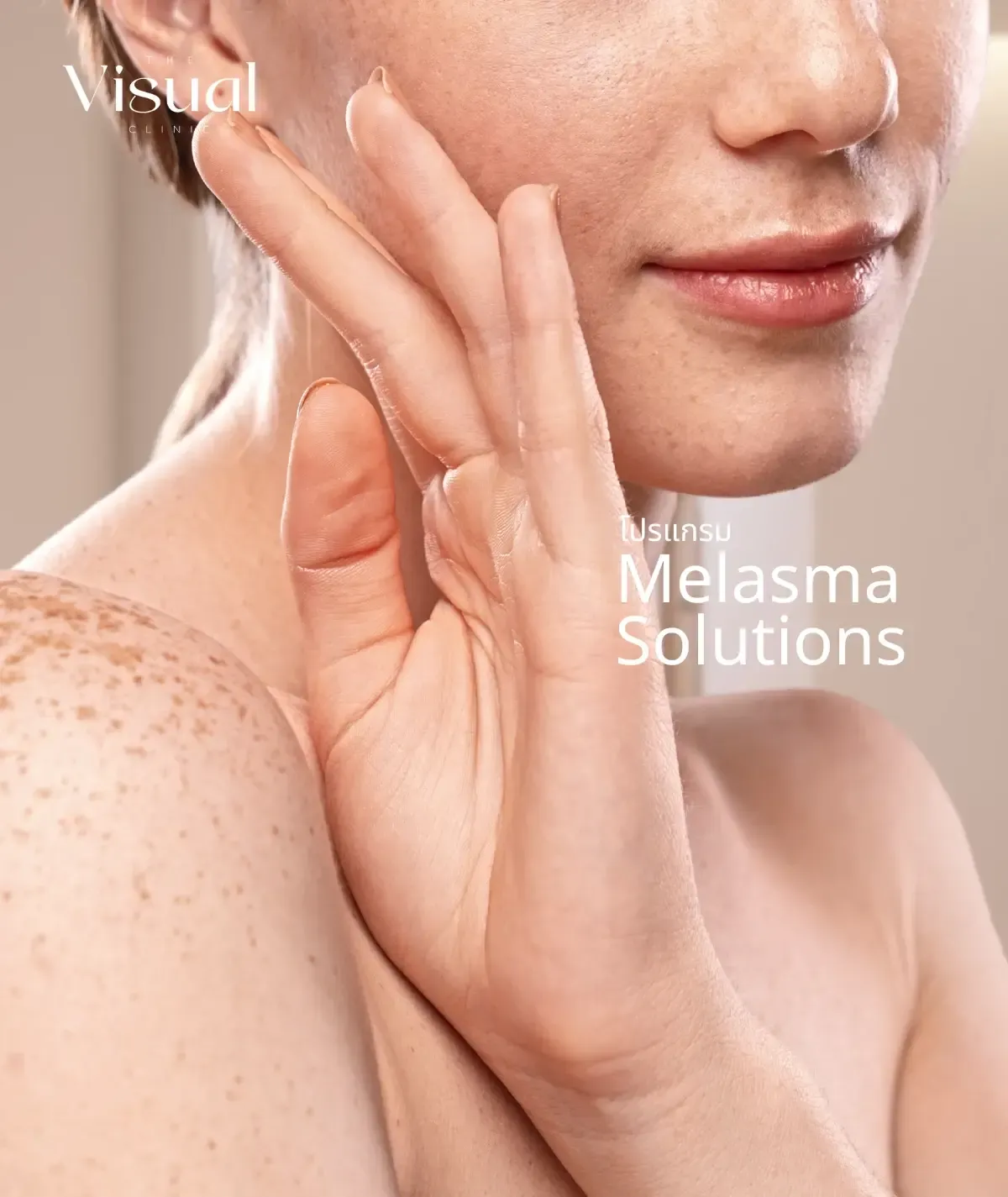 Program Melasma Solutions