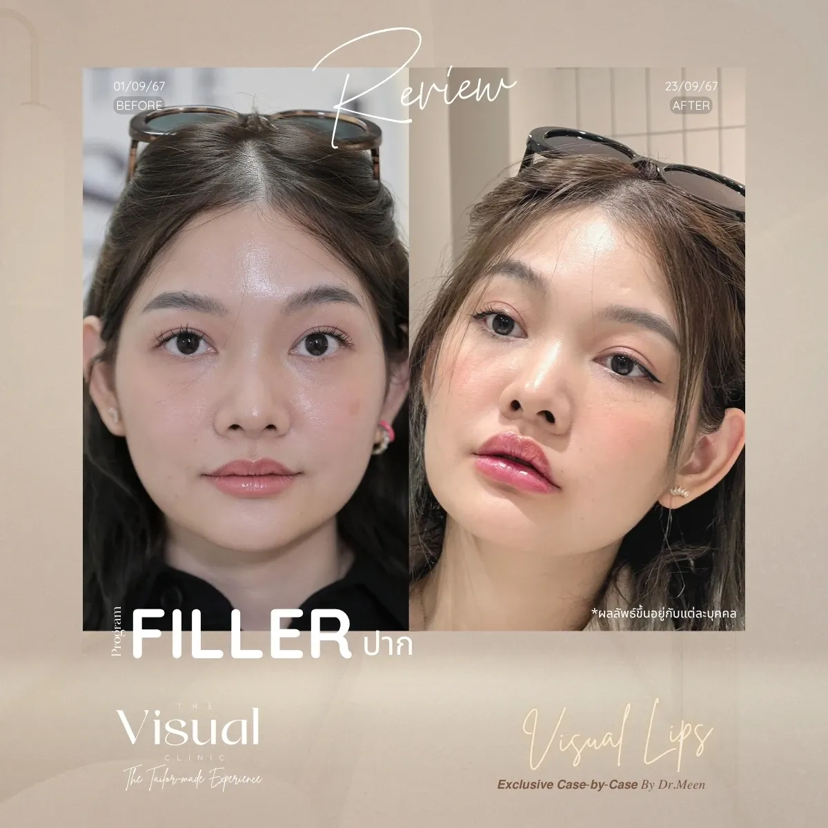 Lips Filler