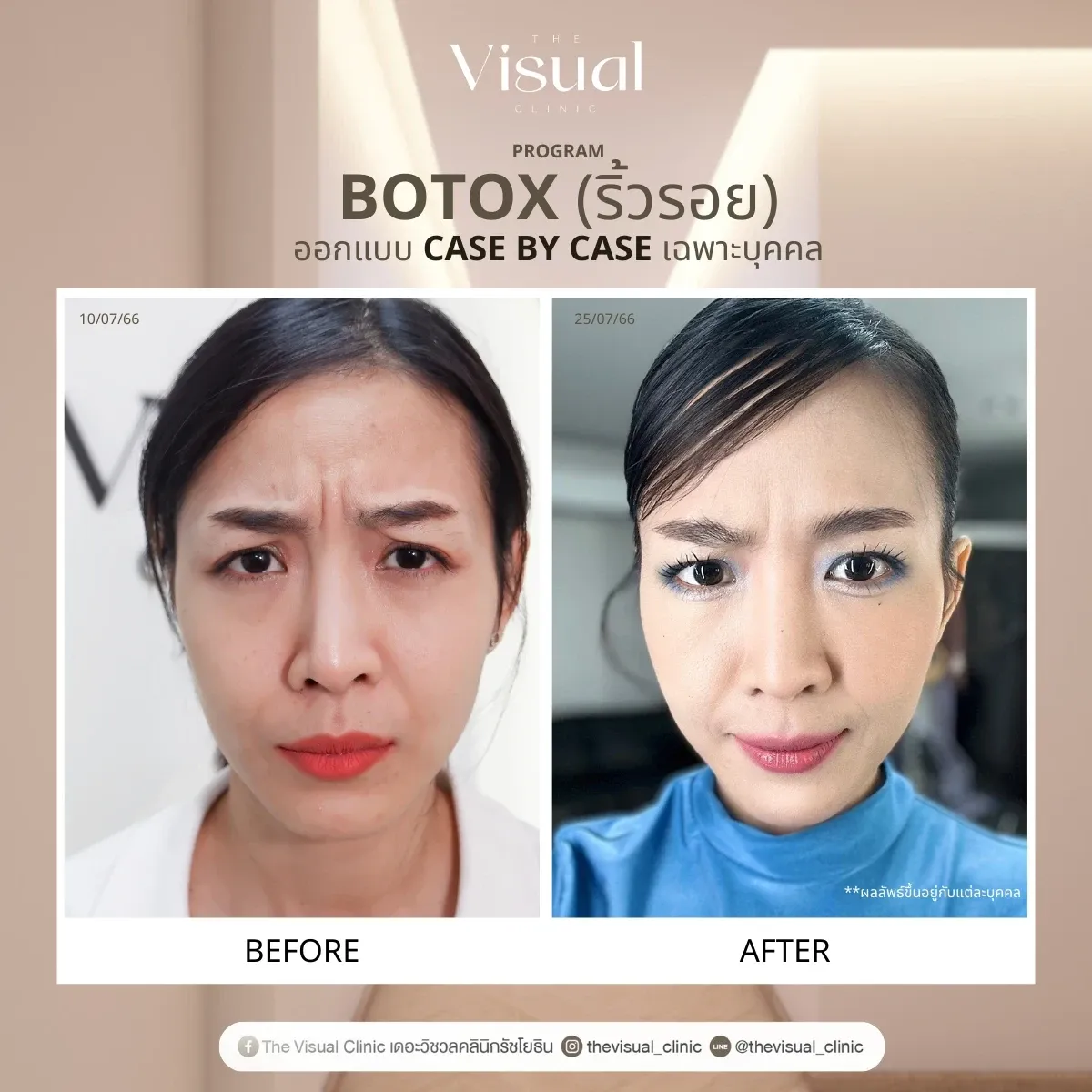 Program Botox