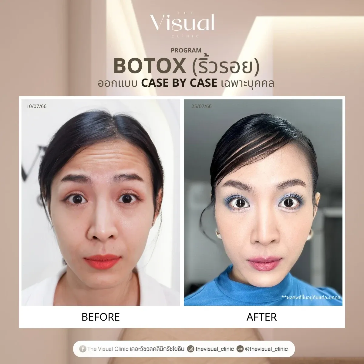Program Botox