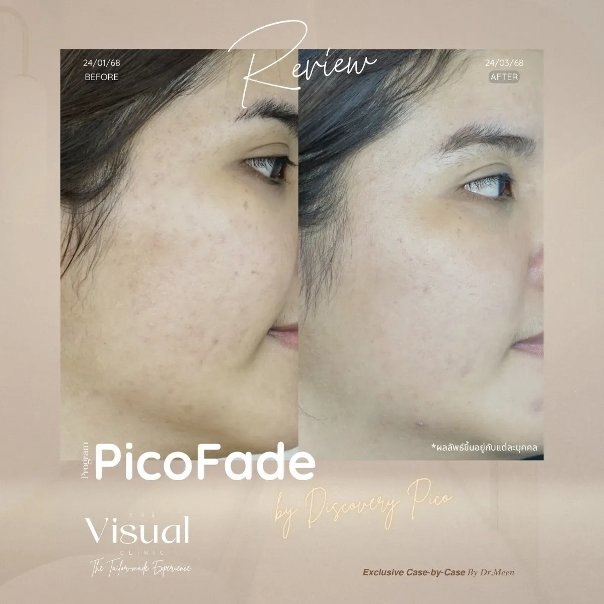 Program Discovery Pico