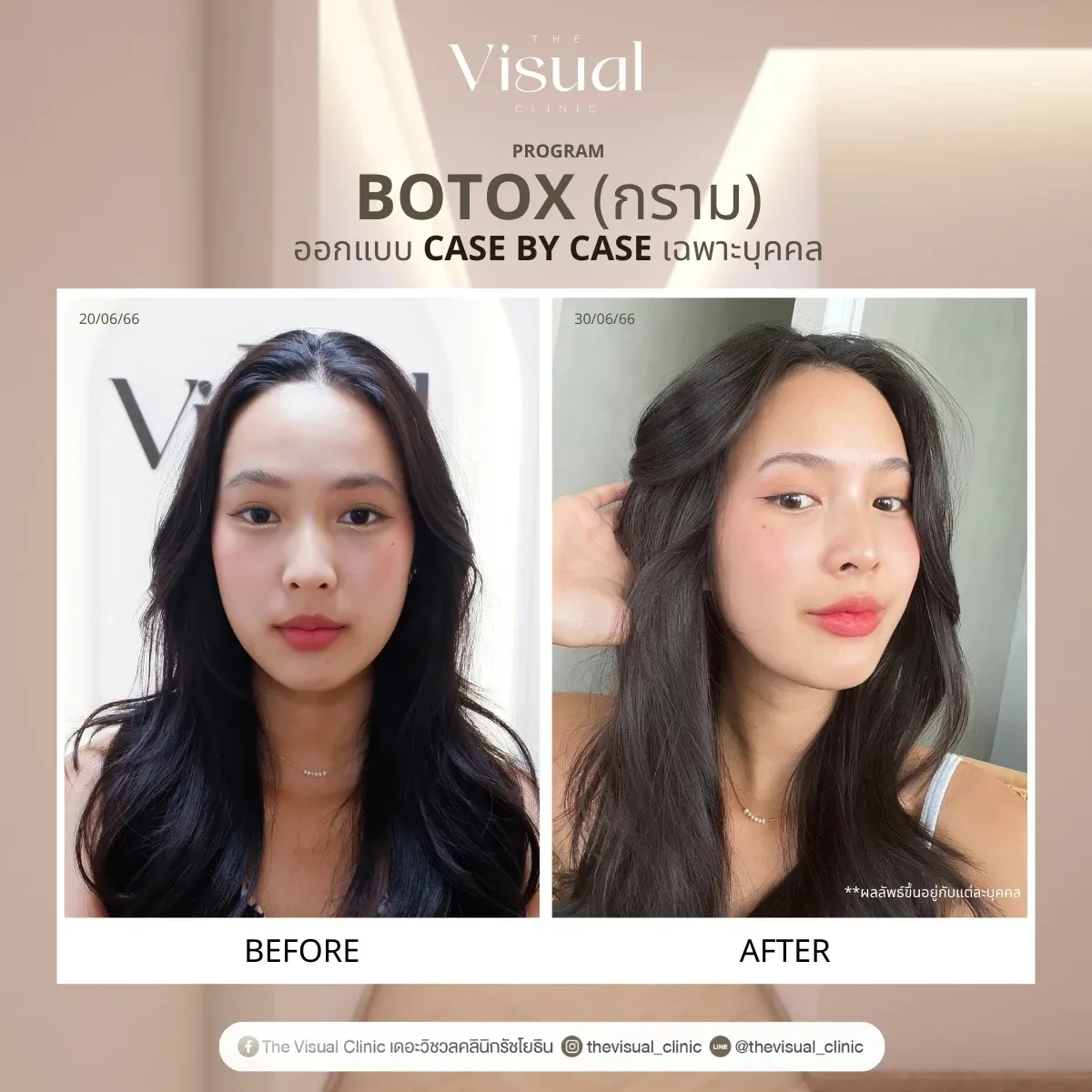 Program Botox