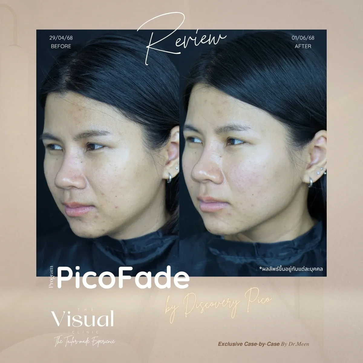 Program Discovery Pico