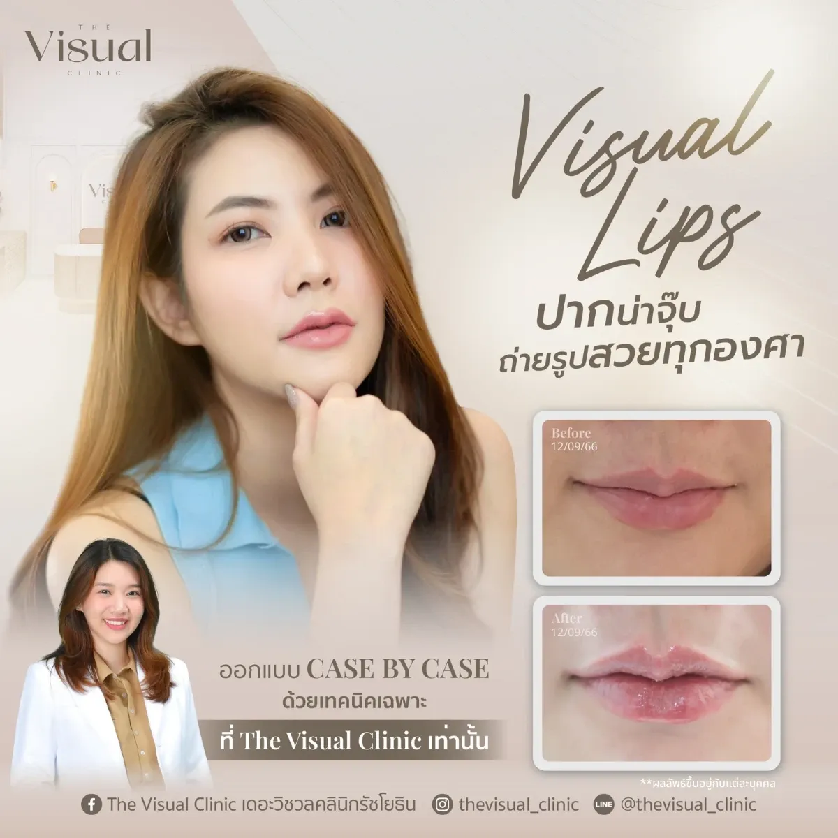 Lips Filler