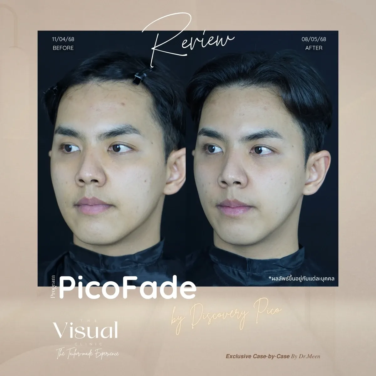 Program Discovery Pico