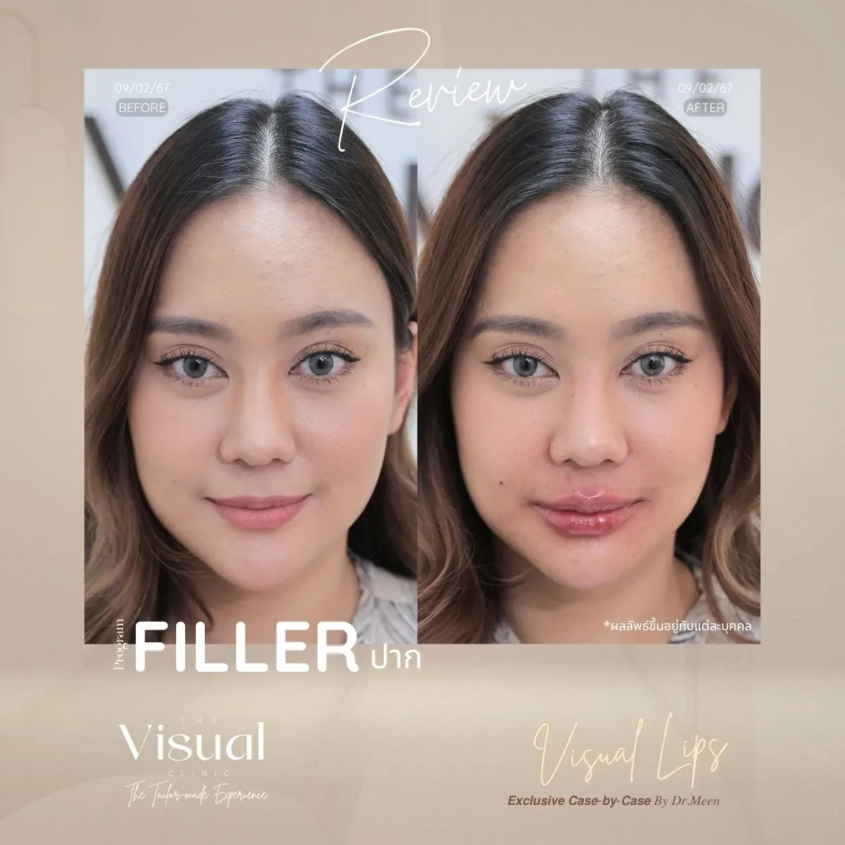 Lips Filler