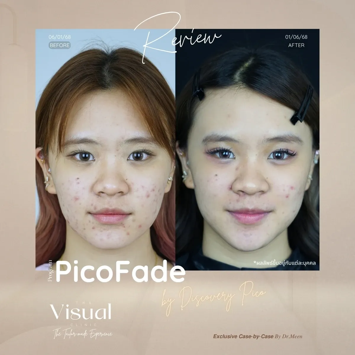 Program Discovery Pico