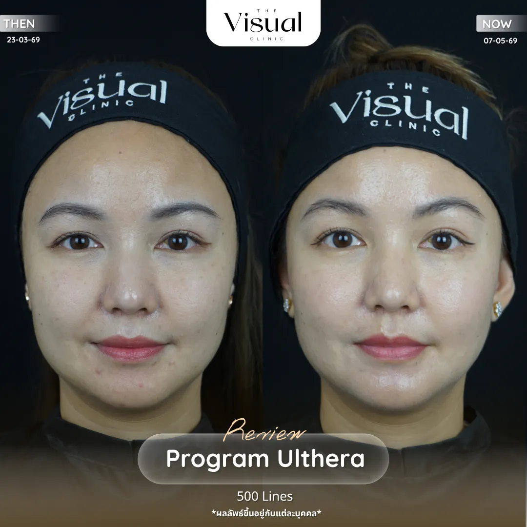 Program Ulthera Prime