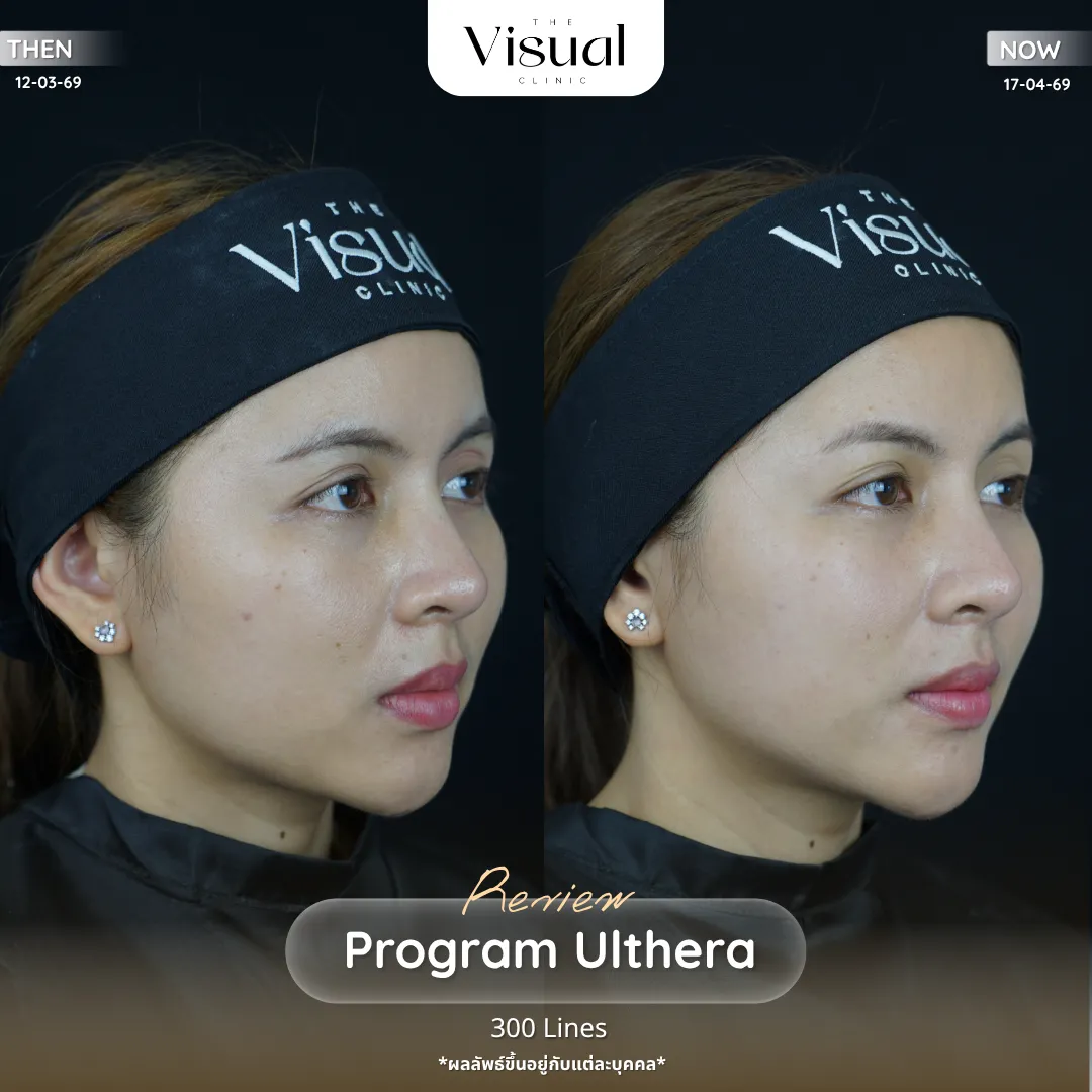 Program Ulthera Prime