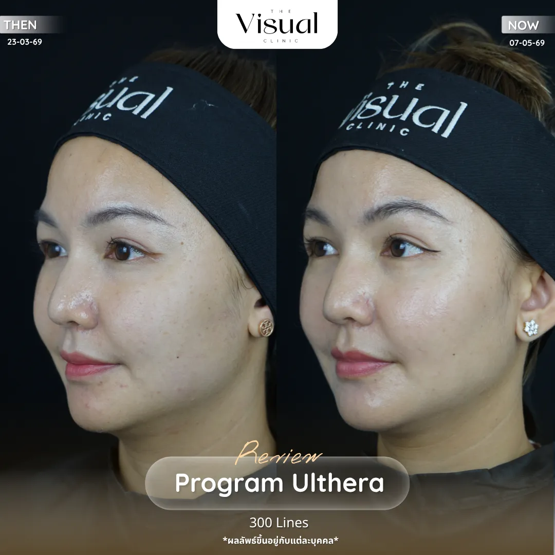 Program Ulthera Prime