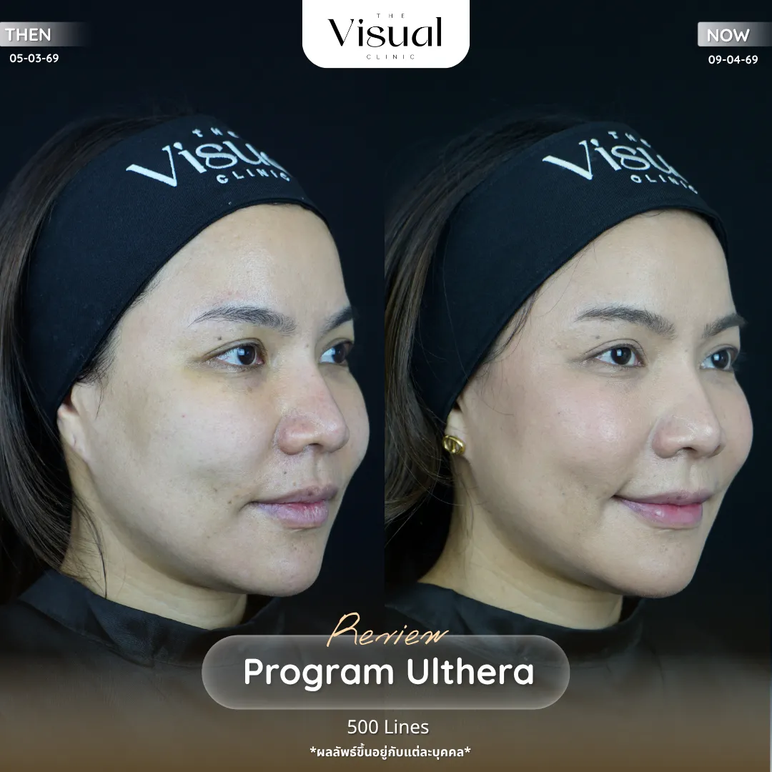 Program Ulthera Prime
