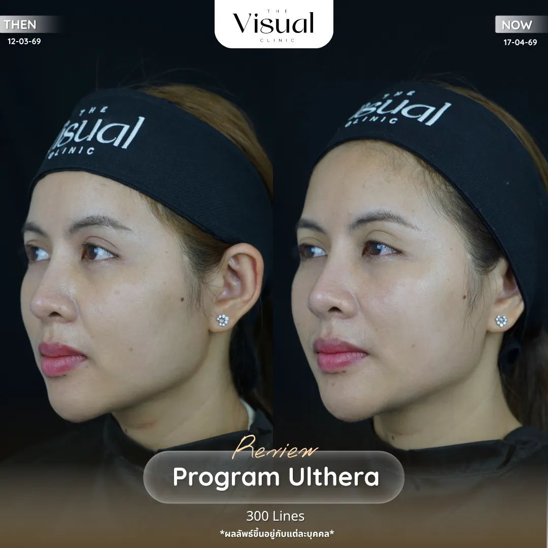 Program Ulthera Prime