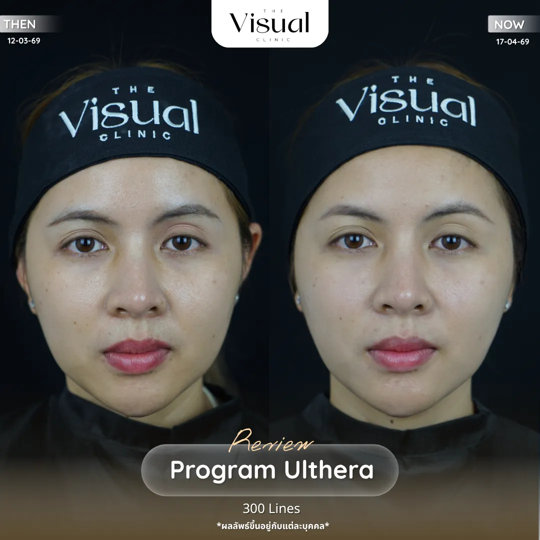 Program Ulthera Prime