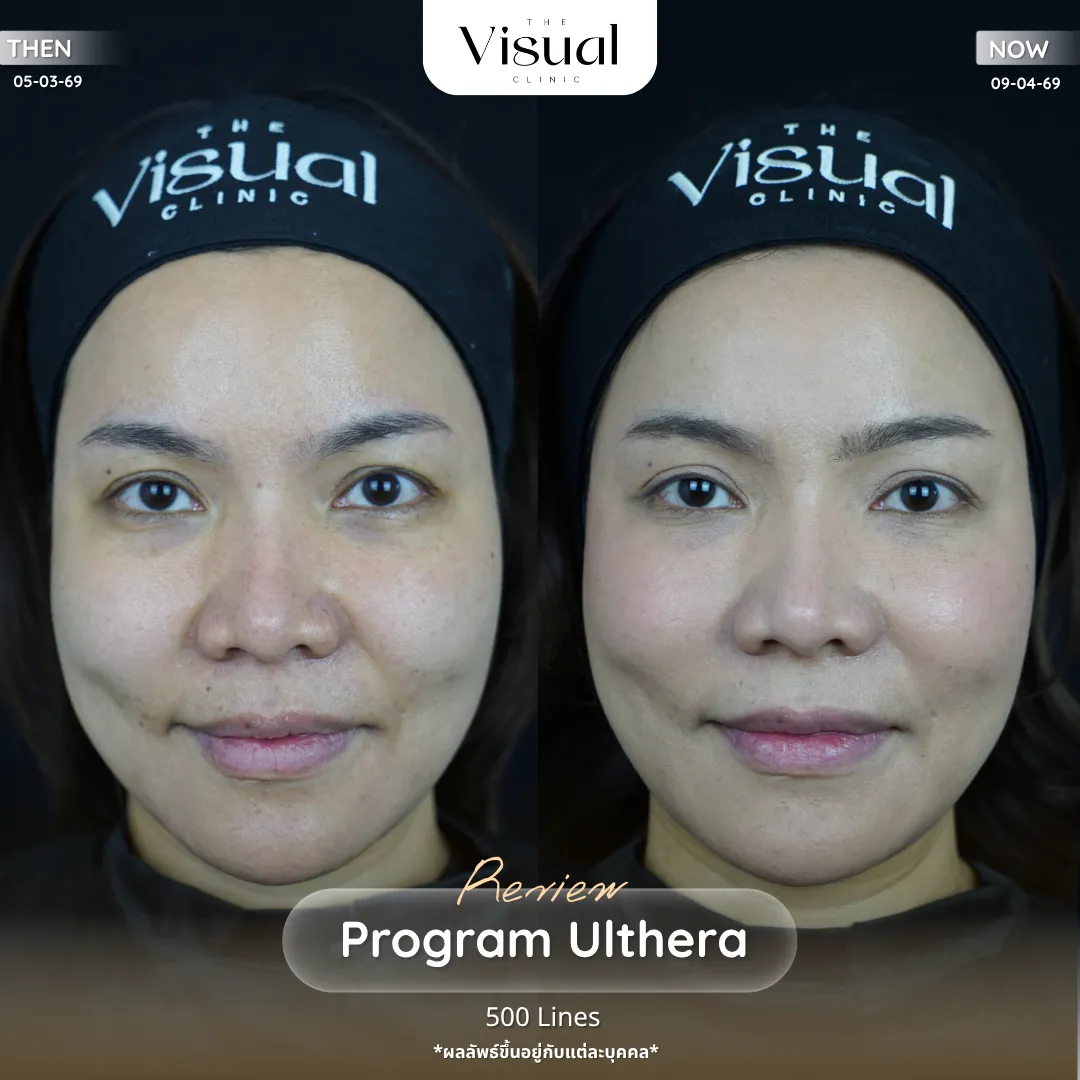 Program Ulthera Prime