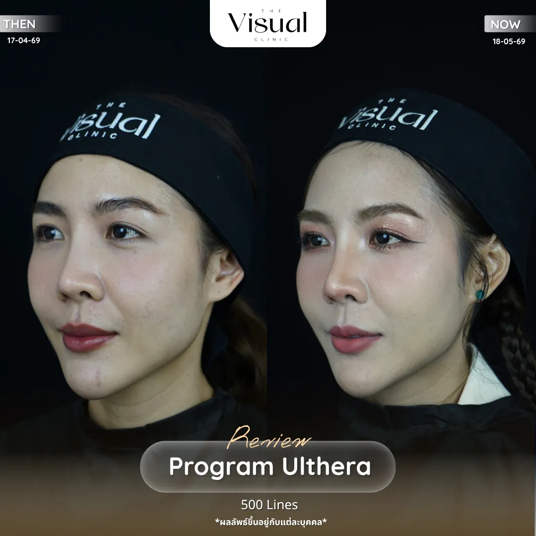 Program Ulthera Prime