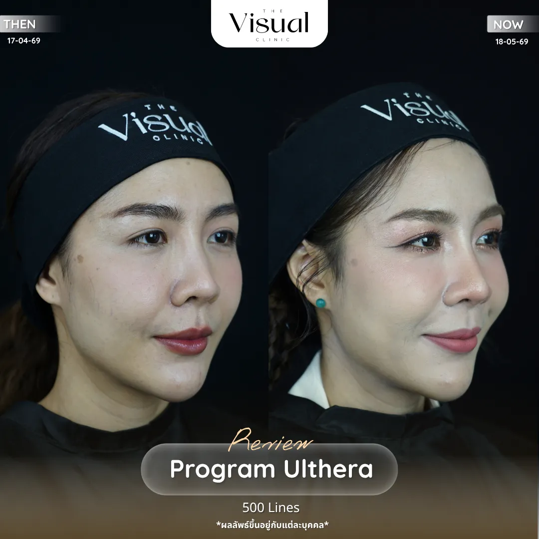 Program Ulthera Prime