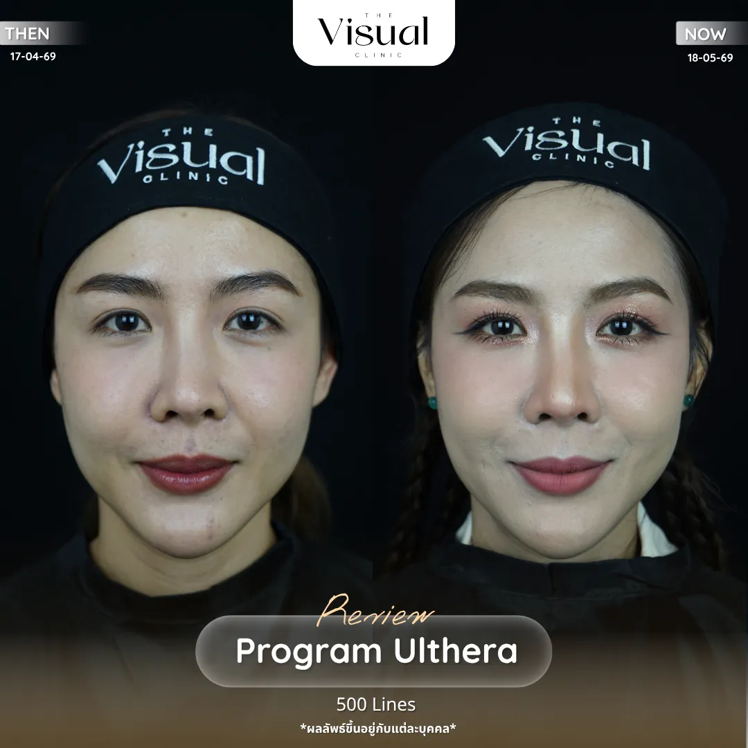 Program Ulthera Prime