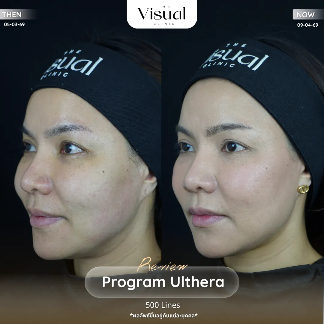 Program Ulthera Prime