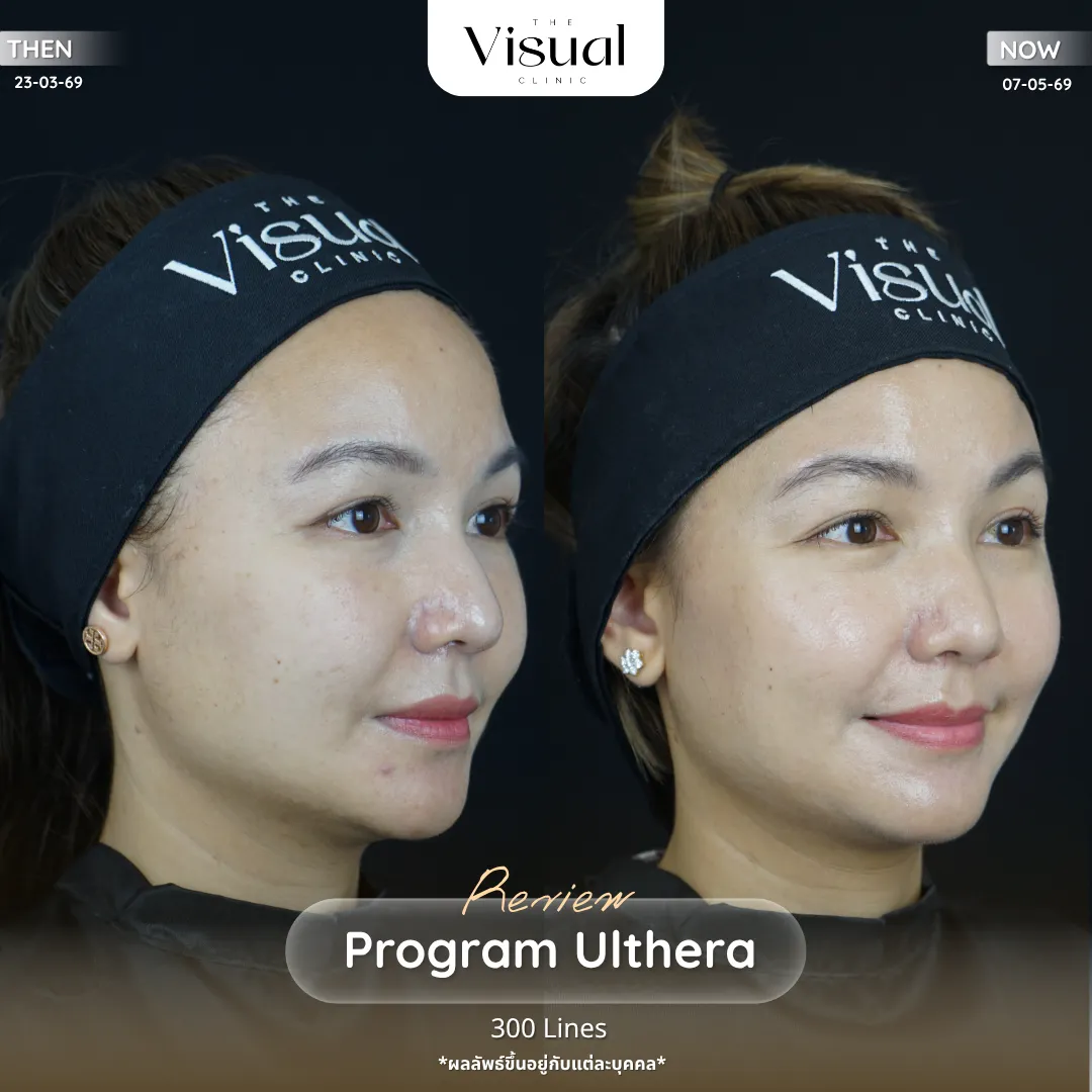 Program Ulthera Prime