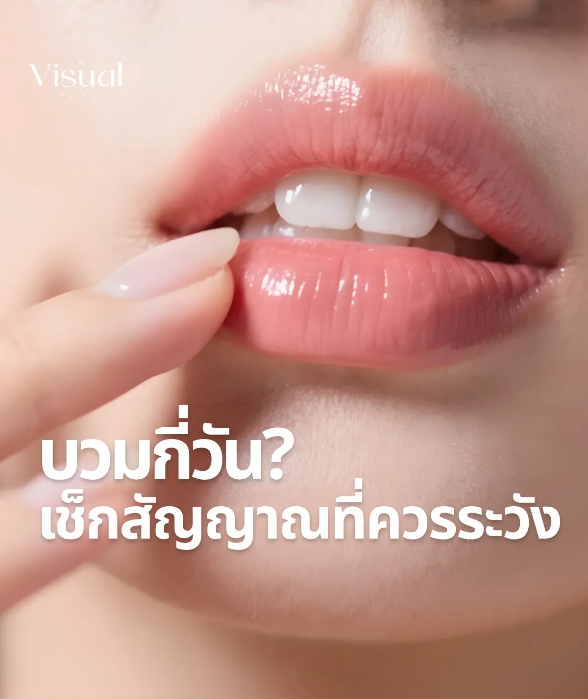 After a Lips Filler Program: How Long Does Swelling Last?